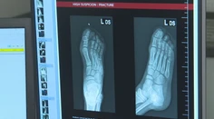 Košickí lekári na urgente využívajú umelú inteligenciu. Dokáže zbadať aj tie najmenšie zlomeniny