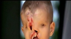 Chlapčekovi so znetvorenou tvárou pomohol Facebook