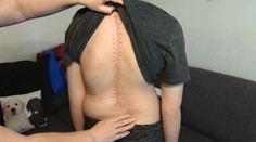Chlapec (17) má celú chrbticu posiatu nádormi. Lekár sa do riskantnej operácie nepúšťal