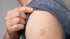 Známa jazva na ramene. Po akom očkovaní vznikla a prečo ju nemá každý