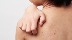 Ekzémy, vyrážky či akné. Prečo sa na jeseň zhoršujú kožné ochorenia a ako sa ich zbavíte?