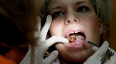 Zubári nesmú od júla používať amalgámové plomby pri týchto pacientoch