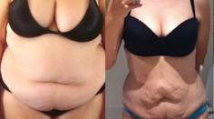 Keď sa chce, všetko sa dá. Žena schudla 70 kíl a je z nej sexy kosť