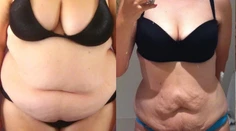 Keď sa chce, všetko sa dá. Žena schudla 70 kíl a je z nej sexy kosť
