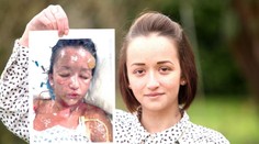 Tínedžerka utrpela strašnú alergickú reakciu na tabletky