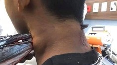 Chlapcovi prebodla krk ryba so špicatou hlavou. Mal obrovské šťastie, že netrafila tepnu