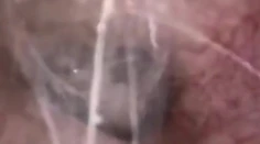 Muža svrbelo ucho. Lekári zostali zhrození, keď zistili, čo sa mu v ňom mrví