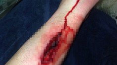 Hororový faul v Premier League! Hráčovi ostala v nohe diera