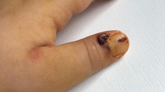 Trháte si kožu okolo nechtov? Môžete skončiť až v nemocnici