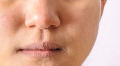 Šupiny na tvári, popraskané pery či tvorba vrások. Naučte sa starať o pleť aj v chladnom počasí