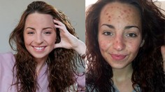 Krásne dievča sa do krvi zohavuje. Nedokáže s tým prestať