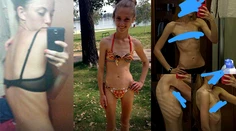Mala 14 a vážila 29 kíl. Posadnutosť chudnutím ich priviedla na psychiatriu
