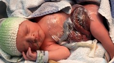 Narodila sa s črevami mimo tela. Dnes je zdravé, krásne dievčatko