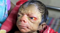 V Bangladéši sa narodilo bábätko s tvárou starca