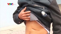 Muž žil 18 rokov s nožnicami v bruchu. Ukázal to röntgen po nehode