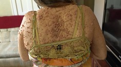 Žena trpí vzácnou chorobou. Roky sa skrývala