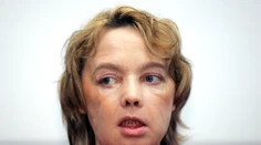 Zomrela žena, ktorej pred viac ako 10 rokmi transplantovali tvár