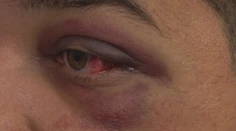 Agresívny vodič v kolóne: Vytiahol bejzbalku a Patrikovi dolámal tvárové kosti