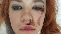 Speváčka zo skupiny Peter Bič Project mala nehodu! Zverejnila desivú fotku
