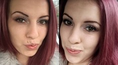 Odmalička má poruchu a je si vlasy. Teraz jej ich vytiahli zo žalúdka