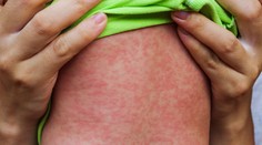 Epidémia osýpok neďaleko Austrálie. Zomrelo už 50 detí