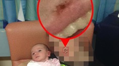 Päťdňové dievčatko takmer zabil bozk