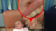 Päťdňové dievčatko takmer zabil bozk