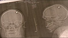 Mladík žil štyri dni s guľkou v lebke. Vôbec o tom nevedel, myslel si, že ho trafil kameň