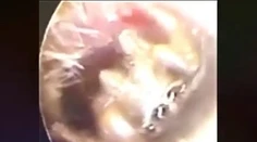 VIDEO: Žena sa sťažovala na bolesť ucha. Doktor v ňom našiel zahniezdeného malého tvora