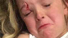 Z domáceho miláčika sa vykľula beštia. Dievča takmer prišlo o oko