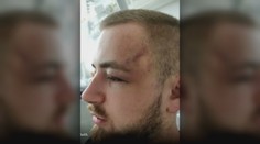 Prípad údajnej policajnej brutality v Košiciach. Je tu aj iná verzia, vraj si muž zranenia spôsobil sám