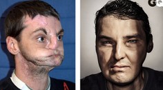 Podstúpil najzložitejšiu transplantáciu v histórii a je z neho model