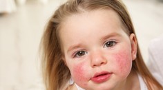 Imunologička: Deti majú byť trochu špinavé aj choré. Tým, že žijeme príliš čisto, narastá počet alergií (rozhovor)