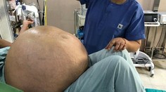 Žene rástol na vaječníkoch mohutný nádor, vážil polovicu z jej hmotnosti