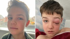 Len deväťročný chlapec po infikovaní sa covidom prežíval muky. Takmer prišiel o oko