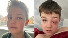 Len deväťročný chlapec po infikovaní sa covidom prežíval muky. Takmer prišiel o oko