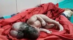 V Indii sa narodilo dieťa s tromi hlavami, doktori zostali v šoku