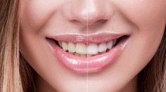 Žltnú vám zuby? Dávajte si pozor na tieto jedlá, nápoje a činnosti