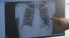 Blížime sa k dôležitej zmene. Rakovinu pľúc zväčša pacientom odhalia až v pokročilom štádiu