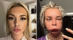 Veronika má vzácne dedičné ochorenie. Opúcha jej tvár či ruky a nikdy nevie, kedy to príde