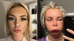 Veronika má vzácne dedičné ochorenie. Opúcha jej tvár či ruky a nikdy nevie, kedy to príde