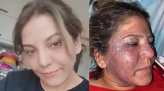 Túžila po vyhladení vrások, po zvláštnom zákroku však skončila s hnisom a opuchmi na tvári