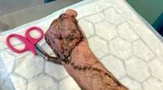 Z drobného škrabanca sa stala vážna infekcia. Mužovi zmenila ruku na nepoznanie