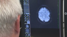 Na najzhubnejší nádor existuje v zahraničí drahá metóda. Poisťovne ju nechcú preplácať