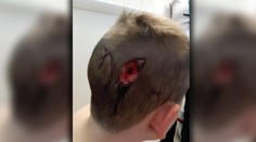 Brutálny útok psov. Chlapec (8) skončil s poranenou lebkou a hlbokou ranou