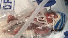 Dievčatko bolo po narodení také malé, že sa zmestilo do dlaní. Takto vyzerá dnes