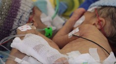 Najmenšie oddelené siamské dvojičky na svete. Mali len osem dní