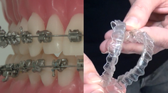 Mnoho dospelých dnes siaha po strojčeku na zuby. Zubní špecialisti radia, aký si vybrať