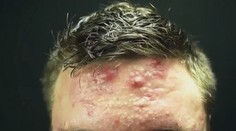 Kulturistu trápilo nechutné akné. Pomohla mu banálna vec