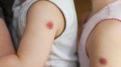 Indiou sa šíri vysoko nákazlivé ochorenie. Pľuzgier podobný paradajke zatiaľ ohrozuje iba deti